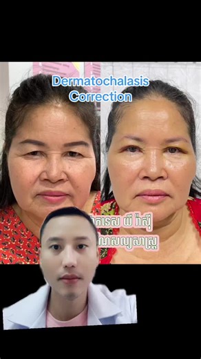 Upper Eyelid Surgery for Dermatochalasis Correction