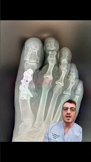 Big Toe Joint Fusion