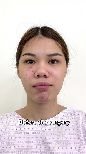 Real People, Real Results: Rhinoplasty Surgery with Dr. Yappy