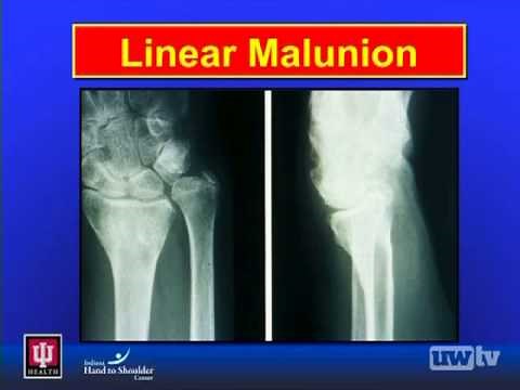 Distal Radius Fractures