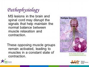 Understanding and Managing Your Spasticity