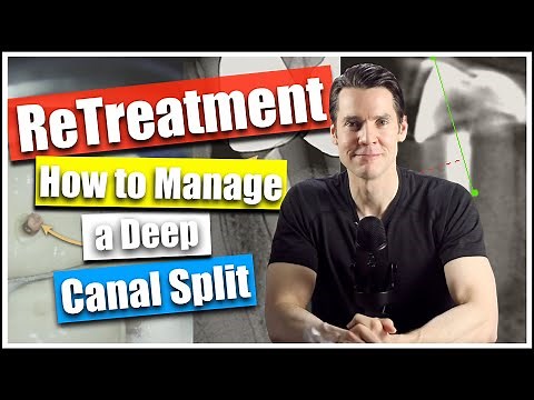 Root Canal Retreatment: How Manage a Deep Canal Split Dr William Nudera, Endodontist