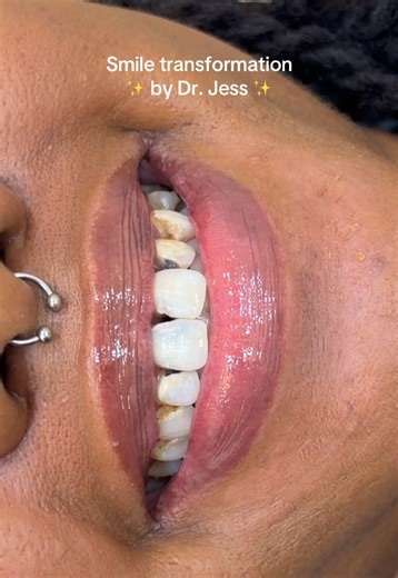 I love a challenging case 😍 This required a combination of restorative dentistry, crowns, and veneers to bring everything together. Situations like this take thoughtful planning and experience, which is why seeing a licensed provider matters.@Art of Aesthetics