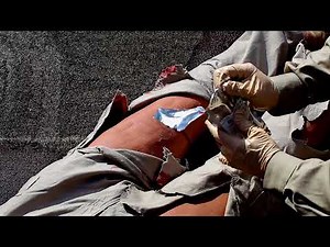 XSTAT for Stopping Severe Bleeding in the Leg