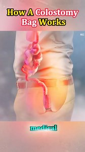 2.5K views · 548 reactions | This 3D animation makes it super simple to understand! From surgery to daily life, here’s how this life-saving device helps millions live comfortably. #HealthAwareness #ColostomyCare #Colostomy #OstomyLife #MedicalAnimation #HealthEducation #HealthcareHeroes #LifeAfterSurgery #OstomyAwareness #MedicalExplained #HealthTips #PatientCare #EverydayHeroes #WellnessJourney #BodyPositivity #ViralVideo #3DAnimation | medical 3d animation video | Facebook