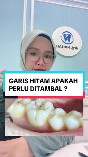 Garis Hitam di Gigi: Apakah Perlu Ditambal?