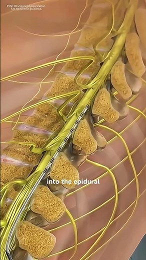 Spinal Cord Stimulator (SCS)Implantation Procedure (3D animation) #music #motivation #epic #like