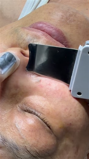 Carin Kim l Los Angeles Esthetician on Instagram: "Gross but satisfying. Extractions are necessary because blackheads are compacted oil and dead skin that need manual removal to clear pores allowing products to absorb effectively 👃. I prep the skin with steam + desincrustation solution and use distilled water while using the modality to clear our pores. #extractions #blackheads #comedones #comedoneextractor ultrasonicexfoliator"