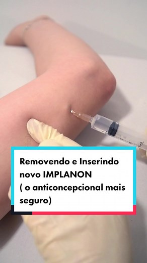 Removendo e inserindo um novo Implanon (o anticoncepcional mais seguro) . Procedimento com anestesia local realizado no consultório. #draliviasaviolo #liviasaviolo #implanon #larc #metodosanticonceptivo