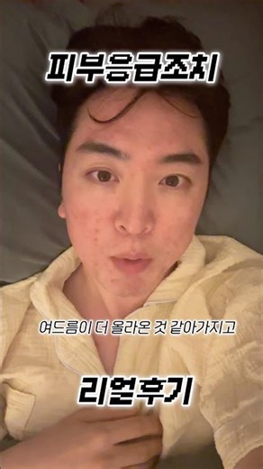 #아젤리아크림 끊고 #병풀 성분 발랐을 뿐인데 🤣 염군의 #피부응급조치 리얼후기 2주차 (#여드름 / #여드름관리)