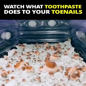 The fungus always came back. Vinegar. VapoRub. Lavender oils. Nothing worked. Then I found out the real problem wasn’t my toes… it was my immune system. Dr. Walters’ 7-second ritual fixed it—and I haven’t looked back. Tap Watch more to finally beat toenail fungus 👇 | Nail Exodus