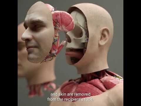 Head Transplant Concept Explained: Using Brain Dead Donor Body for Patients with Cancer or Paralysis