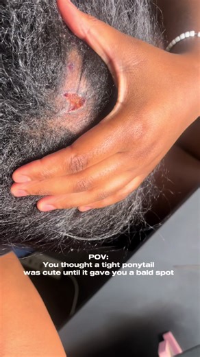 I am so traumatised guys, how do we even fix this? Please give me any recommendations in the comment section below. I wanna restore my hair and have it healthy again. WHEN YOU GET PONYTAILS, MAKE SURE THEY ARE NOT TOO TIGHT! I thought the pain would get better, my biggest mistake, only for me to literally get an infection and hair loss afterwards . #fyp #hairtok #ponytails #baldspot #hairloss