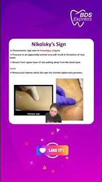 Unveiling the Mystery of Nikolsky Sign: Your Quick Guide to Dermatological Diagnosis!