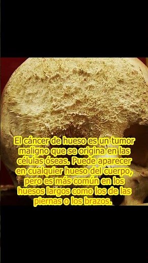 Así luce el cáncer de hueso.