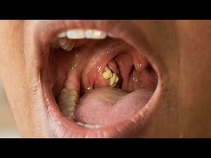 TONSIL STONES REMOVAL AND BAD BREATH