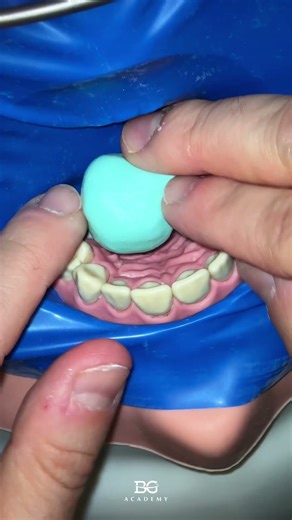 Anterior split dam. #isolation #composite