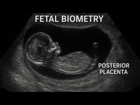 Obstetric Ultrasound showing Fetal Biometry! Placenta Position#ultrasoundmadeeasy86#radiology#uk#usa