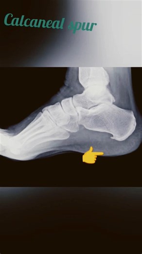Calcaneal spur/ heel spur..