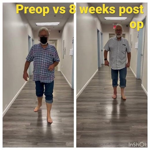 Total ankle replacement recovery using infinity total ankle system #totalankle #arthritis #ankle