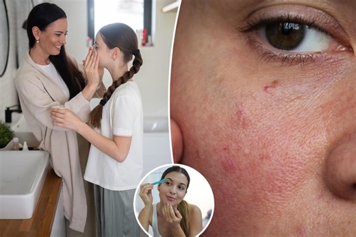Kids and tweens are developing lifelong issues because of their skin care routines, warns derm — the No. 1 culprit