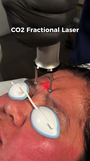 c02 fractional laser #skincareproducts #duet #laser #satisfying