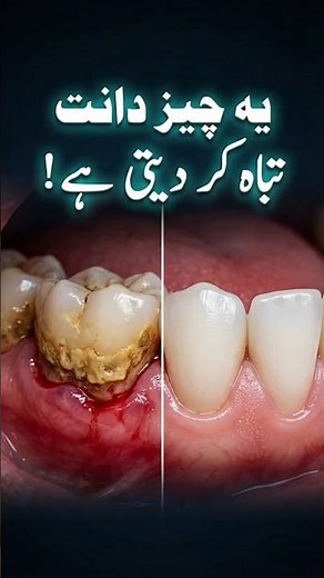 Ye Choti Si Ghalti Aapke Danth Tabah Kar Daiti Hai | Dental Scaling Explained | Dr Aqeel Maqsood