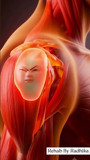 Bursitis Explained | Causes, Symptoms & Physiotherapy Treatment