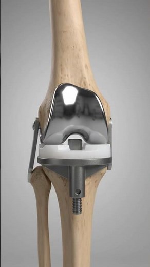 Knee Replacement Explained in 3D 🦵 | How Knee Surgery Works #KneeReplacement #KneeSurgery #3DAnatomy