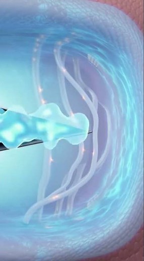 How Spinal Anesthesia Is Given | Complete Real Procedure