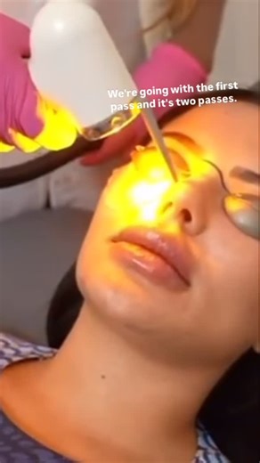 HazelTheBeautyRN🧿🇯🇲🐐👑 on Instagram: "ADVATx is poised to become the laser modality of choice for providers dedicated to offering their patients the most advanced laser solutions available. The combination of high-powered yellow and infrared laser energy is FDA-approved to treat all skin types. Indications include improving skin tone, texture, and overall dermal health by targeting the vascular components of melasma, acne scarring, hyperpigmentation, sun damage, and rosacea while simultaneou