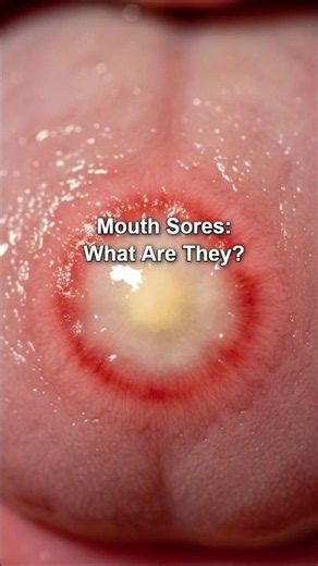 MOUTH SORES : REAL CAUSES !!!