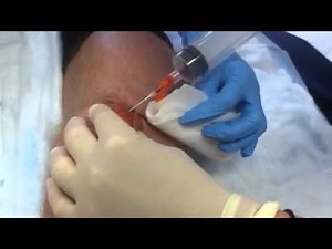 Draining the Bursa sack