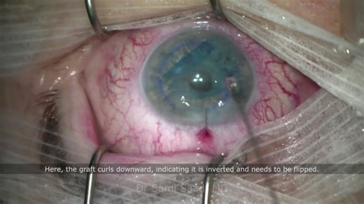 DMEK Surgery Part 2: Step-by-Step Corneal Graft Insertion OCT-Guided Unfolding | Dr Sami A. SAAD | Sami Saad