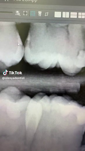 Understanding Interproximal Caries: Prevention and Care
