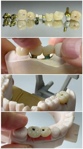 Process custom implants with crowns!