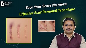 Facial scars caused by injuries, accidents, or surgical stitches can leave a lasting mark on your appearance and confidence. These scars often appear as railroad track-like lines or uneven pigmentation and can be difficult to live with daily. Fortunately, advanced scar removal treatments such as laser resurfacing offer effective solutions. This video explains how laser scar removal works, using USFDA-approved technologies like CO2 fractional lasers, microneedling radiofrequency, and Q-switched N