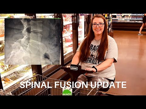 SPINAL FUSION - 8 weeks post op/About surgery and recovery update
