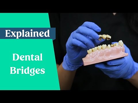 Dental bridges explained (False teeth alternative)