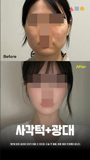 사각턱수술+광대축소 후기