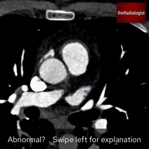 the Radiologist | Radiology on Instagram: "Have a look at the video clip then swipe left for the explanation OCCLUDED MID LAD (CT CORONARY ANGIOGRAM, CTCA) 👨🏽‍💻CTCA scans are used to find significant stenoses in the coronary arteries which can then go on and cause myocardial ischaemia. Given advances of CT technology the dose of a CTCA can be much less than it was 10 years ago meaning it is now a great option in the workup of chest pain 👨🏽‍💻Why is it such a good test? ▫️It has a high negat