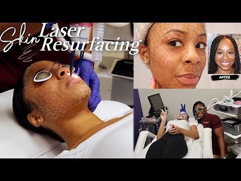 LASER SKIN RESURFACING | What To Expect, Peeling Process, And Final Results ~ Aerolase Era Elite