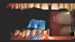 CS scanflow enable to your capture 05 additional bites. Attend our webinar to know many more such features on 20 March, 04 PM by Dr Burzin Khan at https://attendee.gotowebinar.com/register/2051188833134959374 | Carestream Dental | Facebook