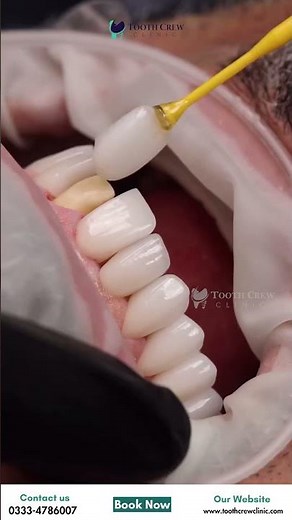 Yellow Teeth Ka Permanent Solution. Veneers Se Hollywood Smile Possible Hai? Full Transformation