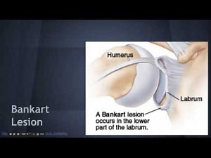 Shoulder Dislocation: Associated injuries - EM in 5