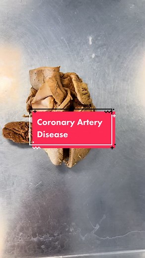 I could’ve said this better — coronary artery disease is the development of plaque that narrows the space within the coronary arteries. If that space becomes completely closed off, that’s what’s called a heart attack. Blod clots can also dislodge from somewhere else in the body and cause a heart attack, but technically that’s not a product of coronary artery disease, or at least, not necessarily. #AnatomyClass #AnatomyIsCool #ScienceClass #CoronaryArteryDisease