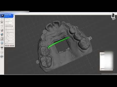 Meshmixer: Fixing Defective Full Size Frame (Dental Lab Tutorial)