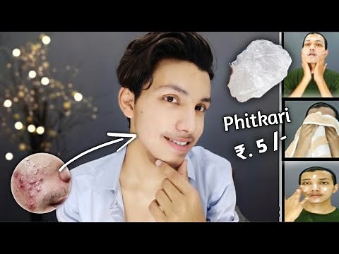 सिर्फ 3 दिन Use कर लो Acne, Pimple, Tiny Bumps खत्म | Phitkari - How To Use | 100% Guranteed Results