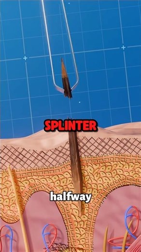 Secret Method To REMOVE a Splinter 😱