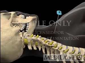 Cervical Spine Selective Nerve Root Block neuro-surgical animations